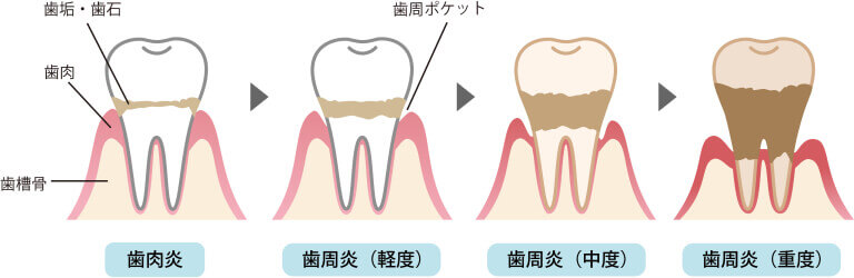 歯周病の進行と症状
